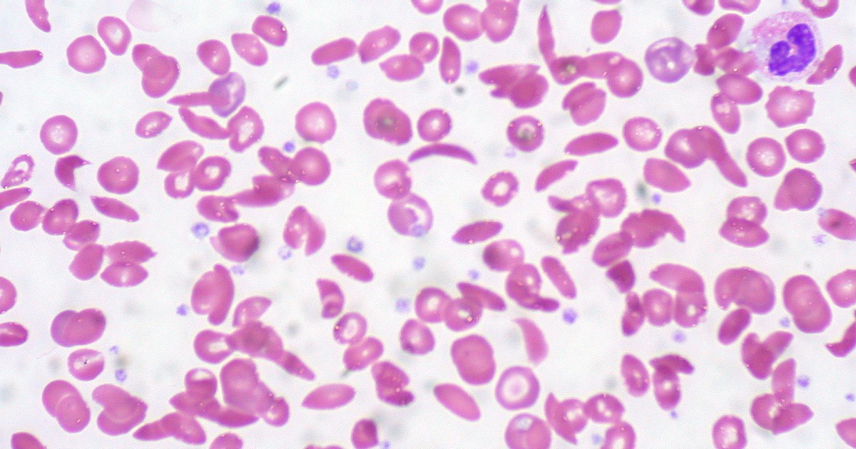 Hemácias rosadas ao microscópio, várias em forma de foice e alongadas, sobre fundo claro