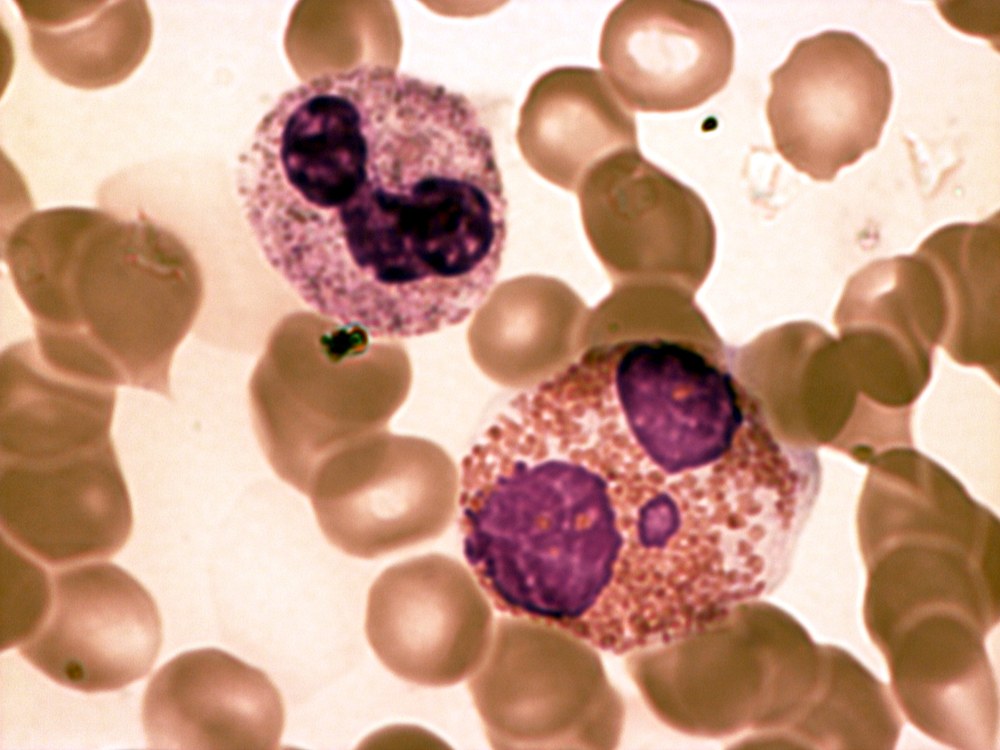 Esfregaço de sangue com um neutrófilo à esquerda e um eosinófilo à direita, entre hemácias