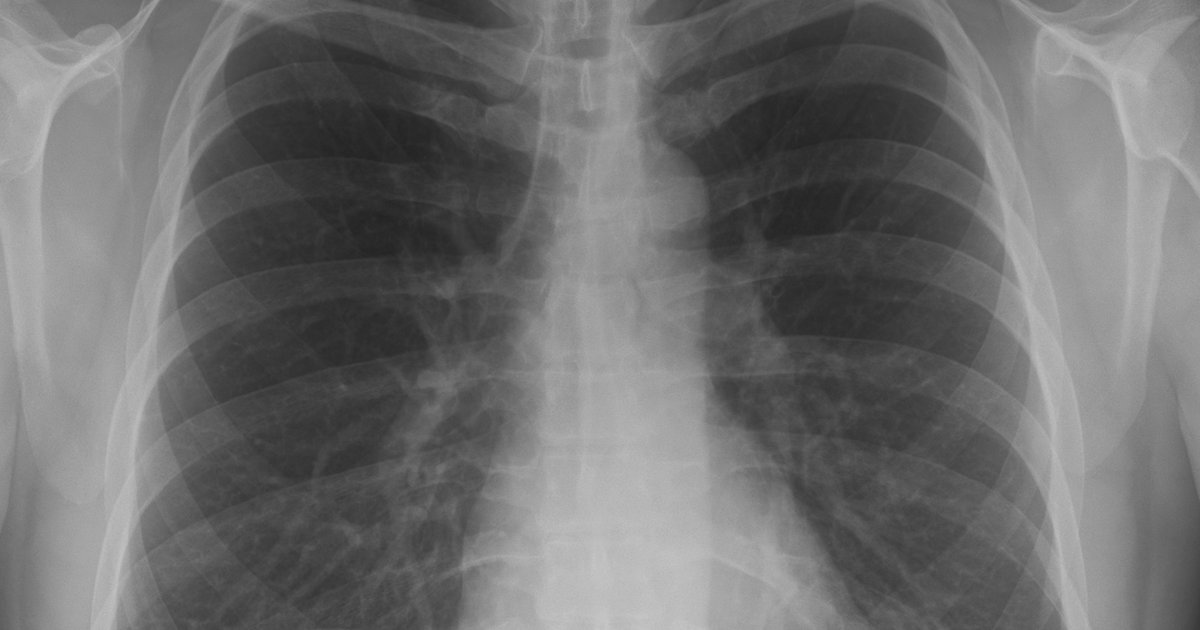 Radiografia de tórax em incidência frontal mostrando pulmões, costelas e silhueta do coração