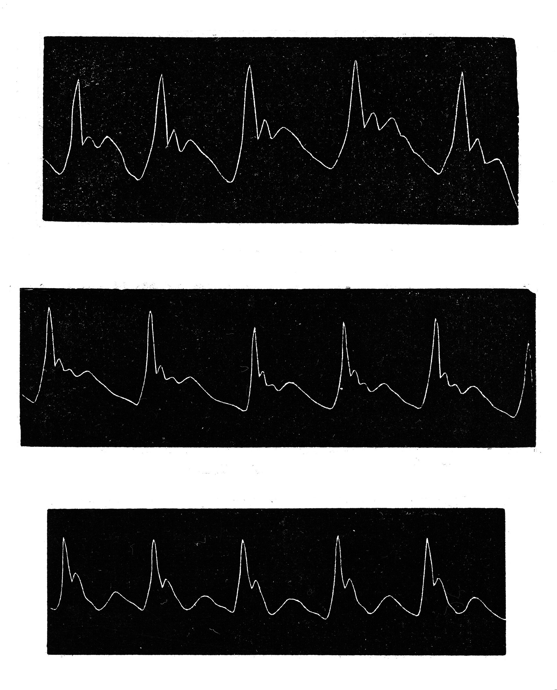 Trois tracés de pouls en noir et blanc, l'un sous l'autre : de fines lignes blanches sur des bandes noires, chacune avec cinq pics aigus suivis de petites ondes.