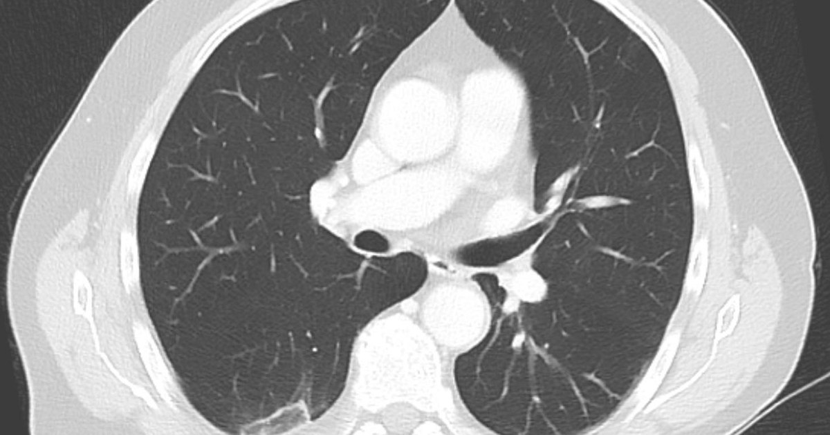 Corte axial de tomografia de tórax em janela de pulmão de paciente com embolia pulmonar
