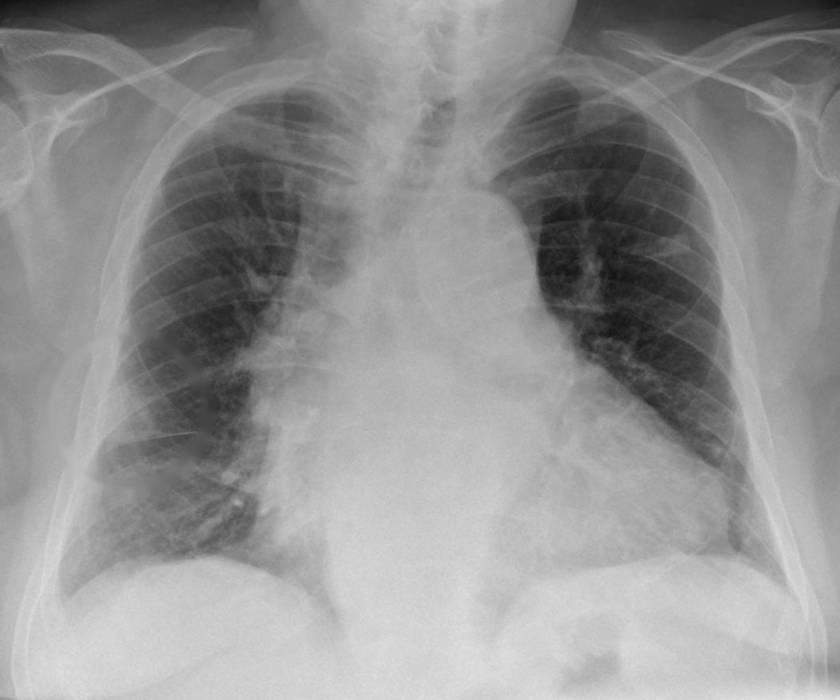 Radiografia de tórax em tons de cinza de paciente com embolia pulmonar grave, com opacidade periférica no pulmão