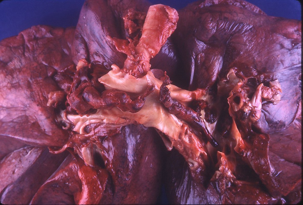 Peça anatômica de pulmão com trombo em sela ocupando a bifurcação das artérias pulmonares