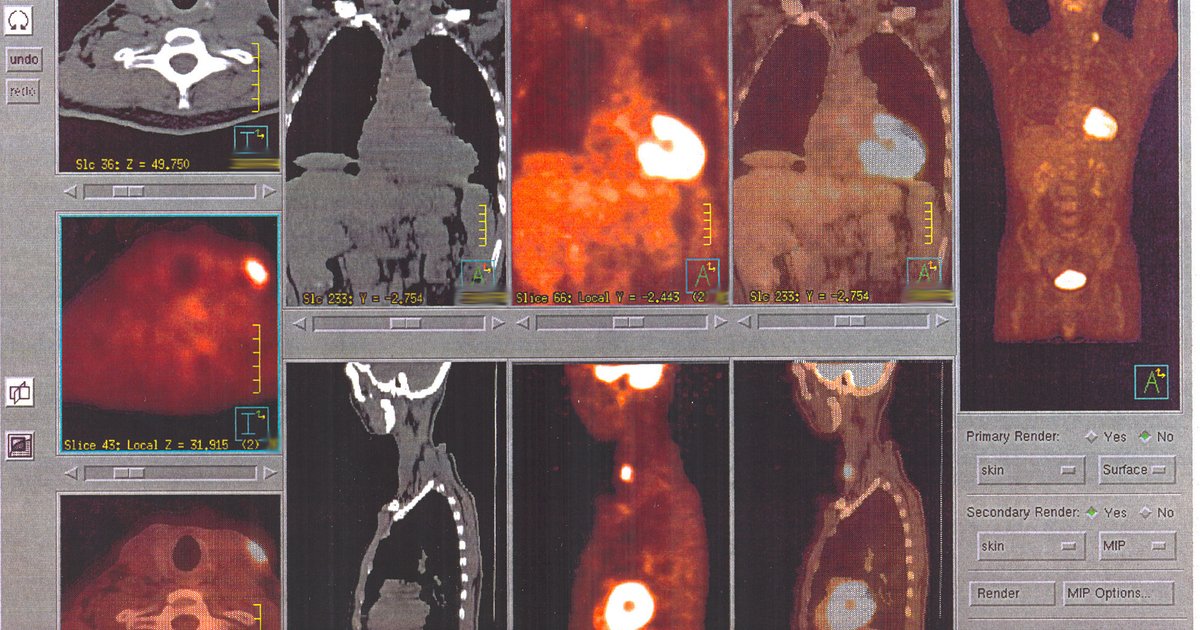 Tela de computador com imagens de PET-CT em cortes coronais, sagitais e axiais, com focos de captação em laranja
