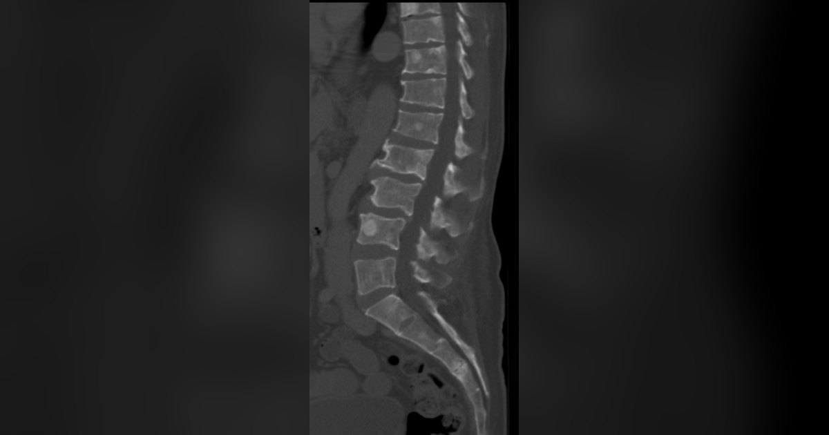 Corte sagital de tomografia da coluna lombar e do sacro mostrando vértebras com pequenas áreas claras arredondadas no interior dos corpos vertebrais