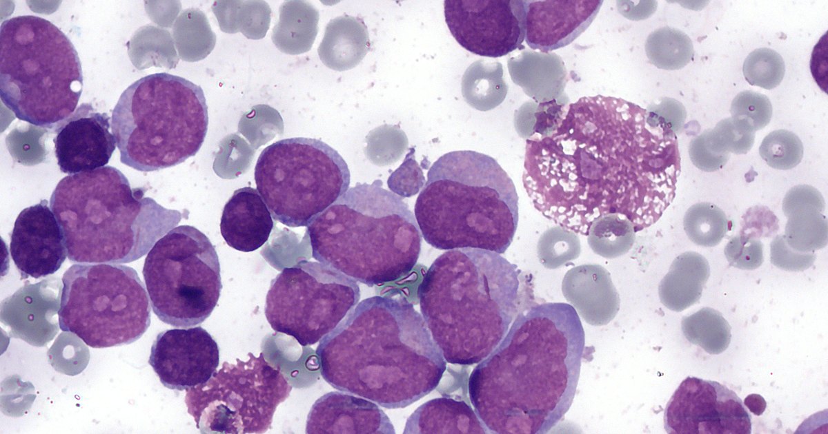 Micrografia de medula óssea com muitas células grandes de núcleo roxo entre hemácias claras